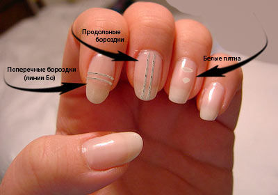 Что означают белые пятна на ногтях и надо ли с ними бороться?