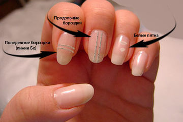Что означают белые пятна на ногтях и надо ли с ними бороться?